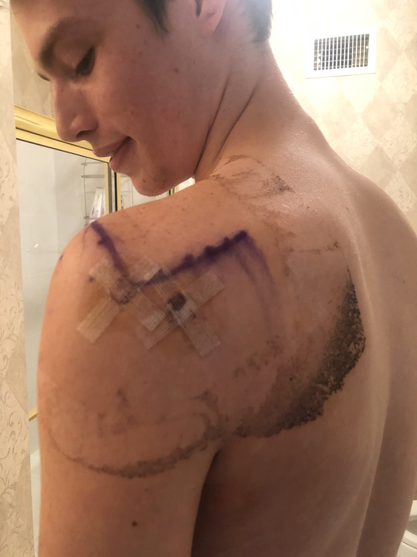Post-op shoulder after first SLAP repair surgery in 2021